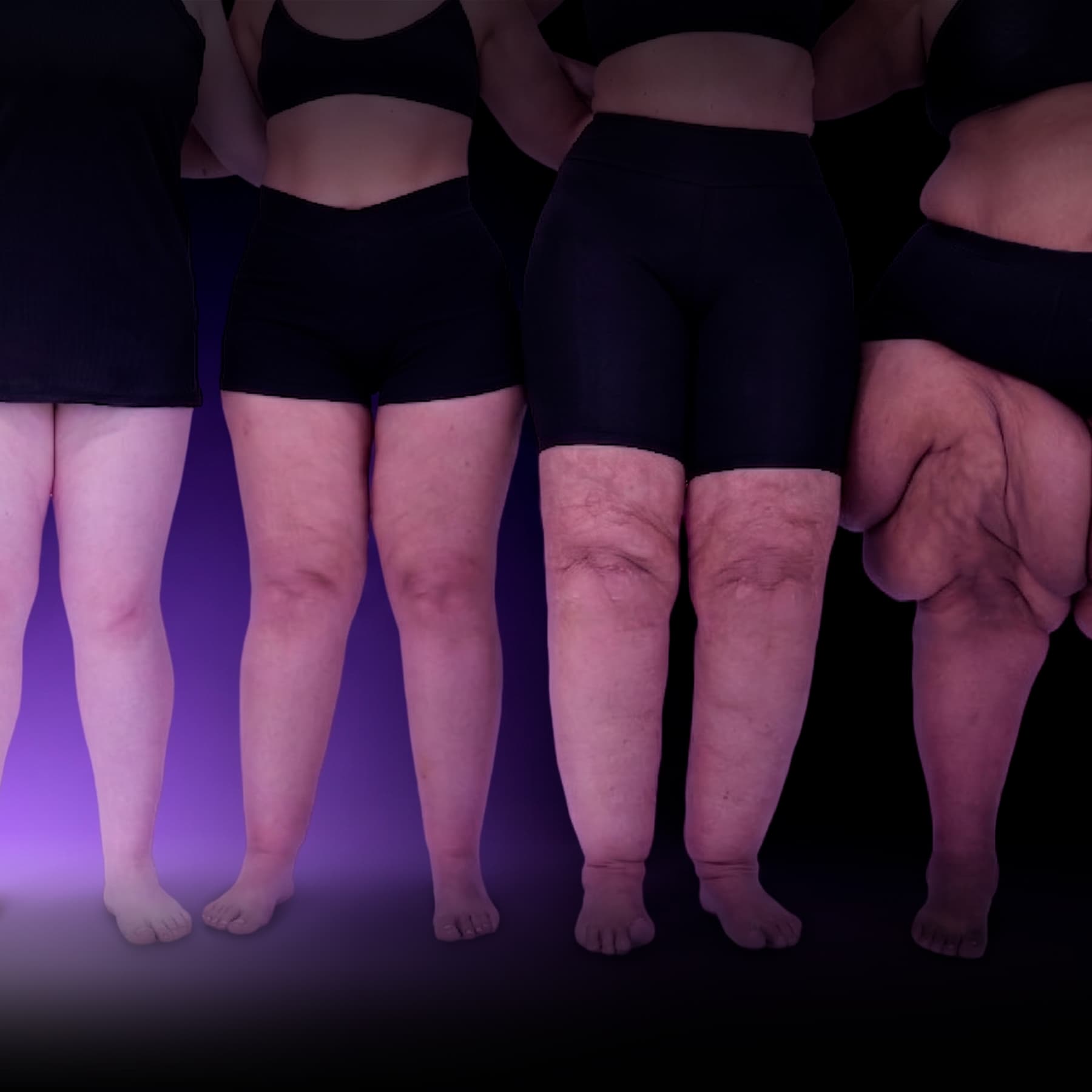 Avaliação e Diagnóstico do Lipedema — formação médica de base do Lipedema Academy
