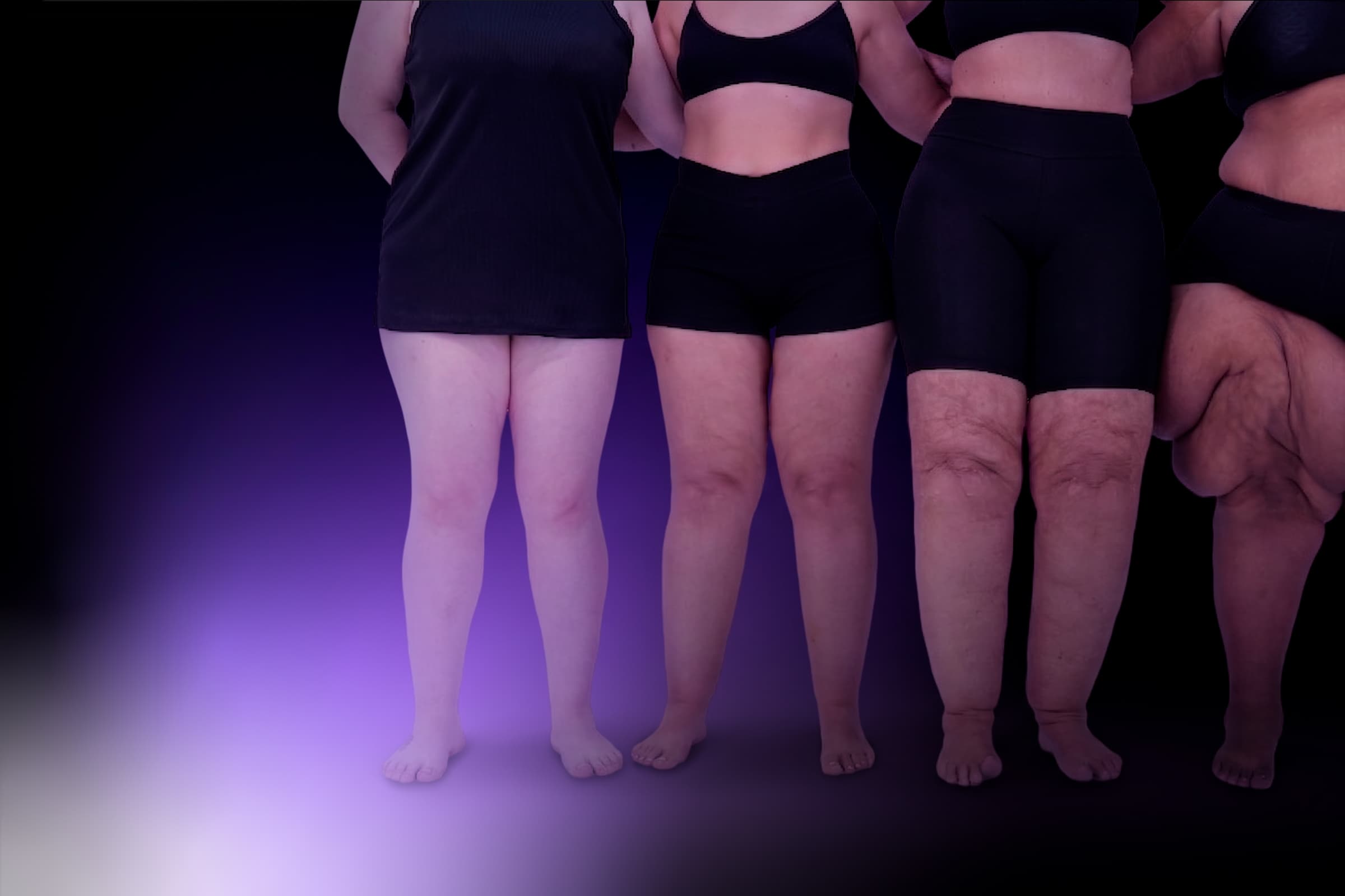 Avaliação e Diagnóstico do Lipedema — formação médica de base do Lipedema Academy